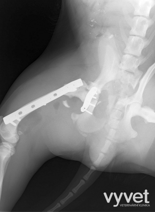 Fraktura acetabula s kompletní frakturou stehenní kosti